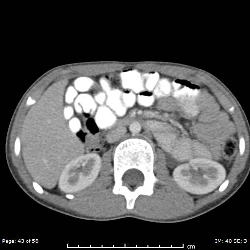 Agenesis of the gallbladder (Radiopaedia 55454-61905 B 43).jpg