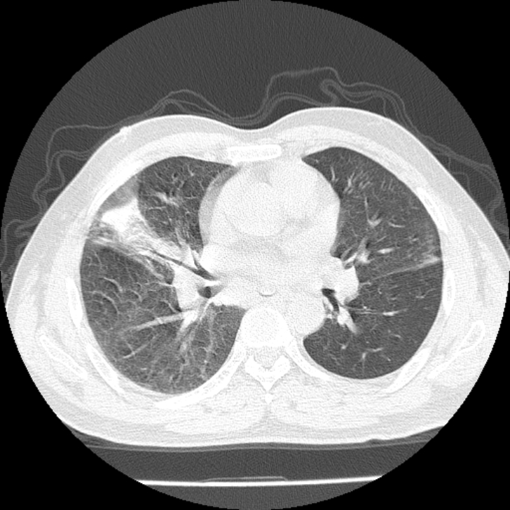 Airway foreign body in adult (Radiopaedia 85907-101779 Axial lung window 90).jpg