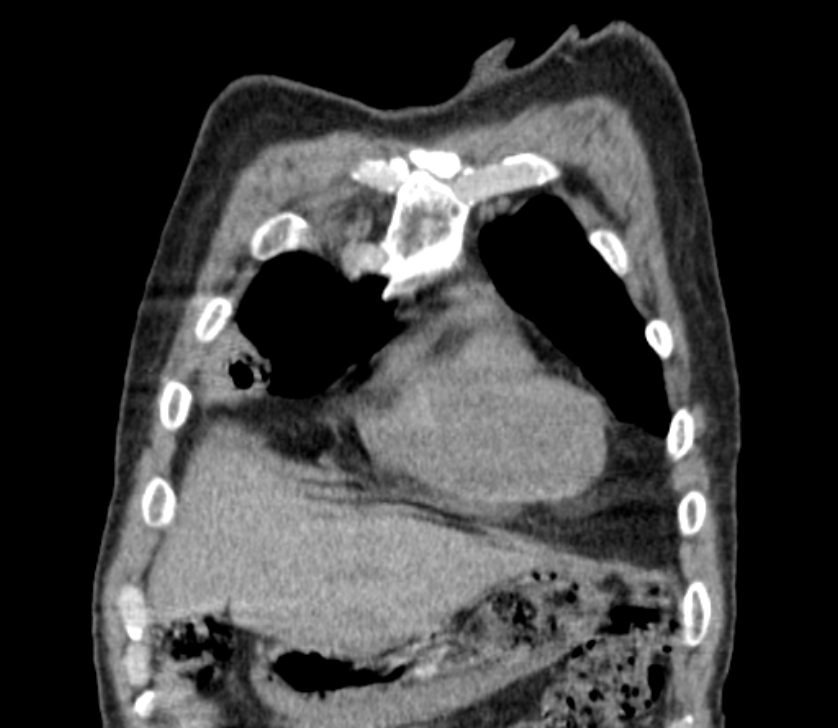 Airway foreign body in adult (Radiopaedia 85907-101779 Coronal liver window 35).jpg