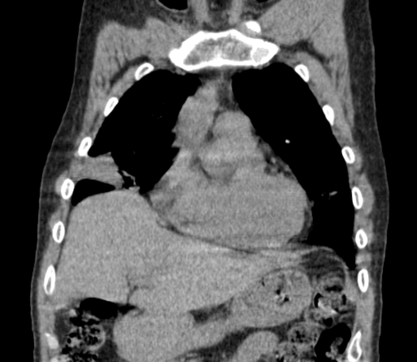 Airway foreign body in adult (Radiopaedia 85907-101779 Coronal liver window 65).jpg