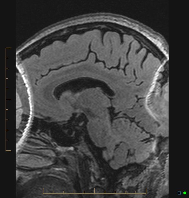Aliasing artifact causing a spurious cerebellar lesion (Radiopaedia 48783-53810 Sagittal FLAIR 30).jpg