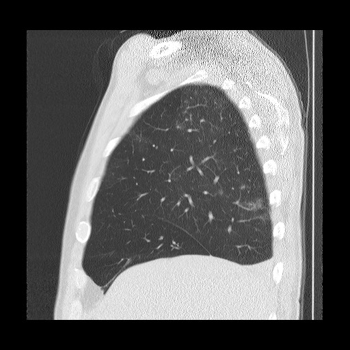 Allergic bronchopulmonary aspergillosis (ABPA) (Radiopaedia 60594-68313 Sagittal lung window 47).jpg