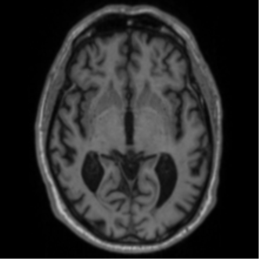 Alzheimer's disease- with Gerstmann syndrome and dressing apraxia (Radiopaedia 54882-61150 Axial T1 35).png