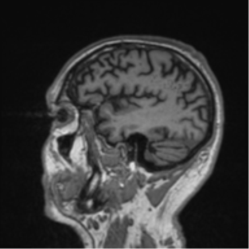 Alzheimer's disease- with Gerstmann syndrome and dressing apraxia (Radiopaedia 54882-61150 Sagittal T1 13).png