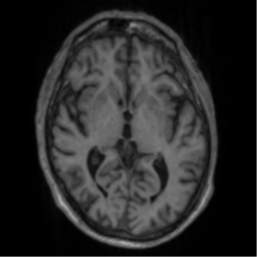 Alzheimer's disease- with apraxia (Radiopaedia 54763-61011 Axial T1 37).png
