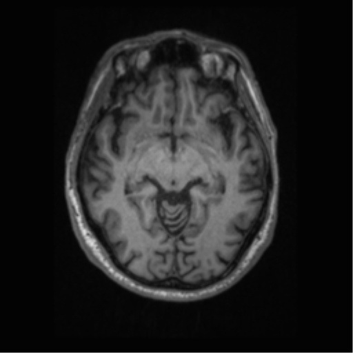 File:Alzheimer disease - probable (Radiopaedia 35334-36837 Axial T1 35).png