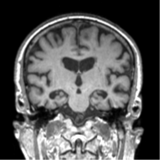 Alzheimer disease and cerebral amyloid angiopathy (Radiopaedia 64234-73011 Coronal T1 31).png