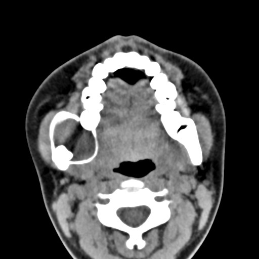 File:Ameloblastoma (Radiopaedia 26645-26793 Axial C+ delayed 19).jpg