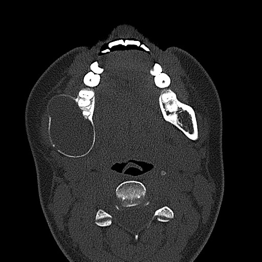 File:Ameloblastoma (Radiopaedia 26645-26793 E 36).jpg