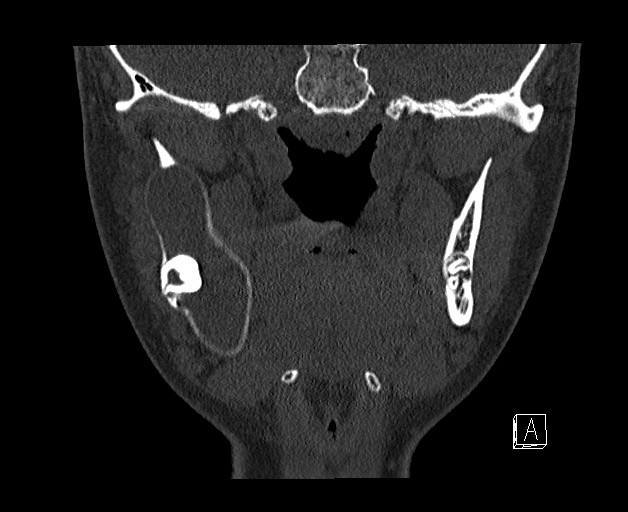 File:Ameloblastoma (Radiopaedia 26645-26793 bone window 17).jpg