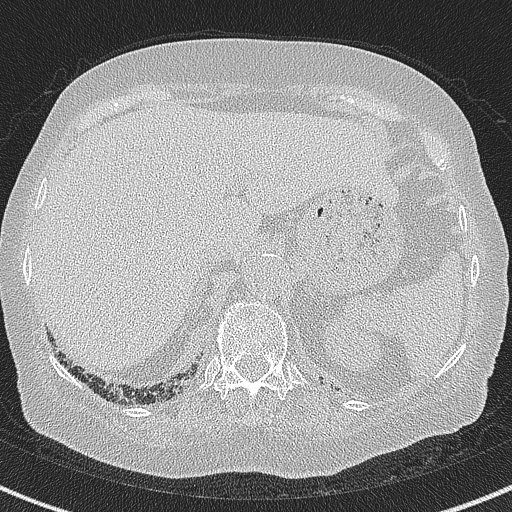 File:Amiodarone-induced pulmonary fibrosis (Radiopaedia 82355-96460 Axial lung window 64).jpg