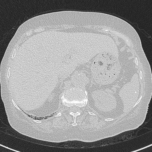 Amiodarone-induced pulmonary fibrosis (Radiopaedia 82355-96460 Axial lung window 66).jpg