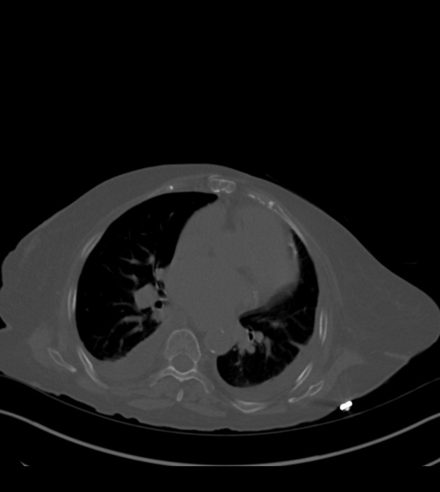 Amiodarone deposition in the liver (Radiopaedia 77587-89780 Axial bone window 44).jpg