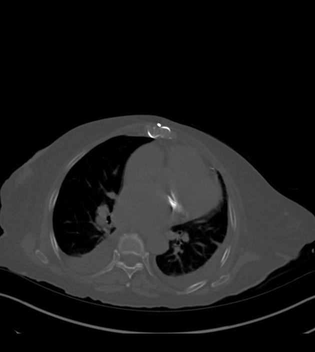Amiodarone deposition in the liver (Radiopaedia 77587-89780 Axial bone window 47).jpg