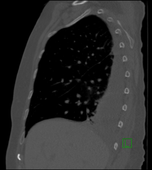 Amiodarone deposition in the liver (Radiopaedia 77587-89780 Sagittal bone window 70).jpg