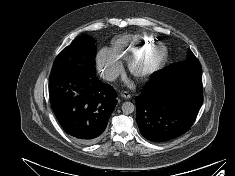 Amiodarone lung (Radiopaedia 62514-70769 Axial non-contrast 63).jpg