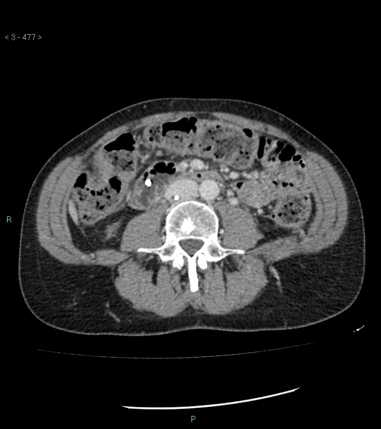 Ampulla of Vater metastasis (Radiopaedia 27820-28069 A 115).jpg