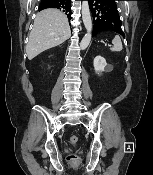 Ampullary adenocarcinoma (Radiopaedia 59373-66734 D 78).jpg