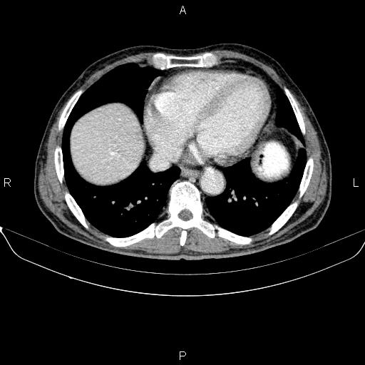 Ampullary adenocarcinoma (Radiopaedia 86093-102032 A 6).jpg