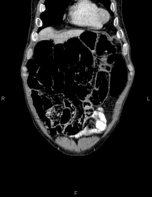 Ampullary adenocarcinoma (Radiopaedia 86093-102032 C 8).jpg