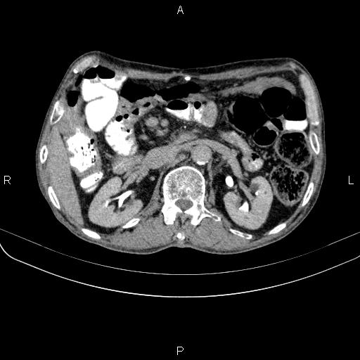 Ampullary adenocarcinoma (Radiopaedia 86093-102033 Axial C+ delayed 46).jpg