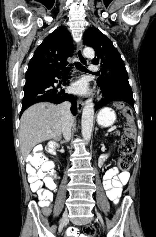 Ampullary adenocarcinoma (Radiopaedia 86093-102033 D 35).jpg