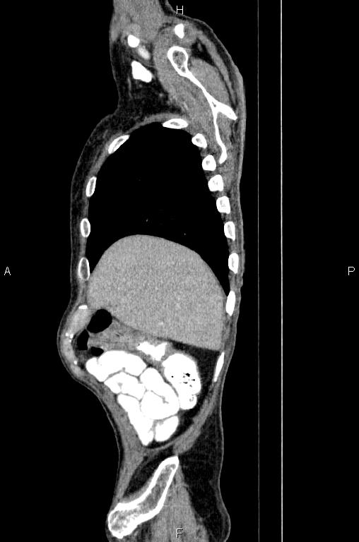 Ampullary adenocarcinoma (Radiopaedia 86093-102033 E 11).jpg