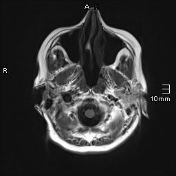 File:Amyotrophic lateral sclerosis (Radiopaedia 70821-81017 Axial T1 4).jpg