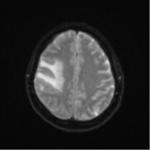 Anaplastic astroblastoma (Radiopaedia 55666-62194 Axial DWI 21).png