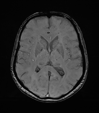 File:Anaplastic astrocytoma (Radiopaedia 86943-103160 Axial SWI 49).png