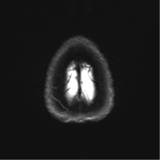 Anaplastic astrocytoma - thalamic glioma (Radiopaedia 59709-67115 Axial DWI 34).png