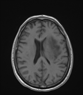 Anaplastic astrocytoma IDH wild-type (Radiopaedia 49984-55273 Axial T1 36).png
