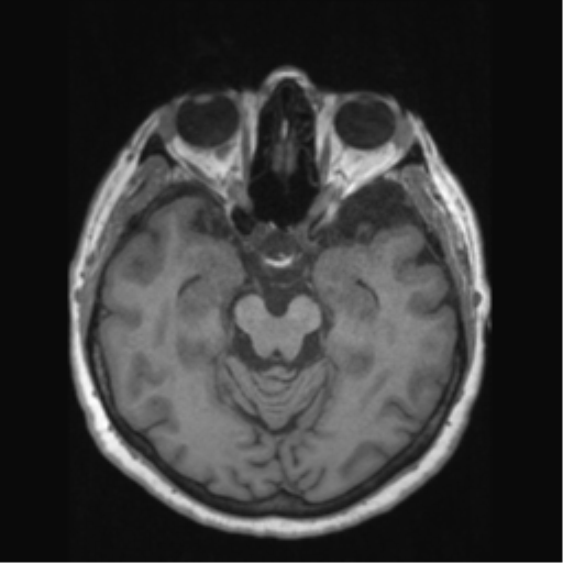 File:Anaplastic astrocytoma IDH wild-type (pseudoprogression) (Radiopaedia 42209-45276 Axial T1 62).png