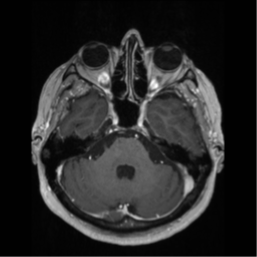 File:Anaplastic astrocytoma IDH wild-type (pseudoprogression) (Radiopaedia 42209-45276 Axial T1 C+ 47).png