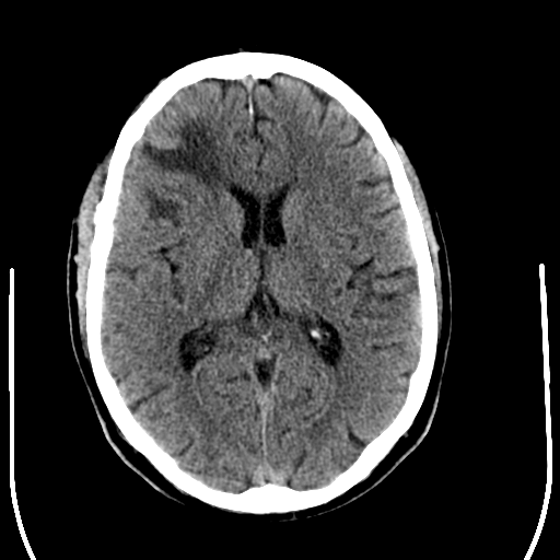 File:Anaplastic meningioma with recurrence (Radiopaedia 34452-35781 Axial non-contrast 18).png