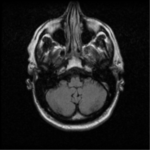 File:Anaplastic meningioma with recurrence (Radiopaedia 34452-35789 Axial FLAIR 5).png