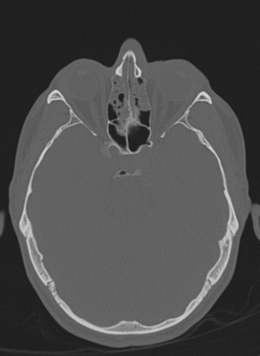 Anaplastic oligodendroglioma with skull fracture (Radiopaedia 74831-85846 Axial bone window 49).png