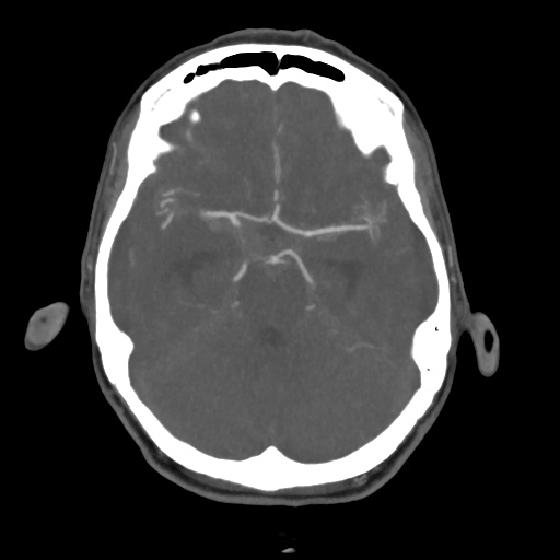Aneursym related subarachnoid hemorrhage with hydrocephalus (Radiopaedia 45105-49084 A 22).jpg