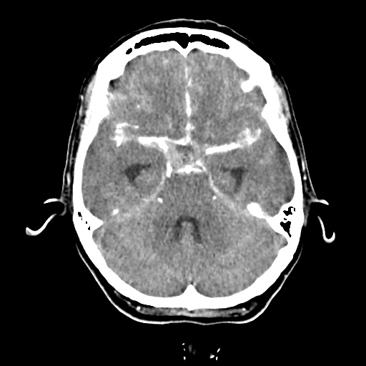 Aneursym related subarachnoid hemorrhage with hydrocephalus (Radiopaedia 45105-49084 D 17).jpg