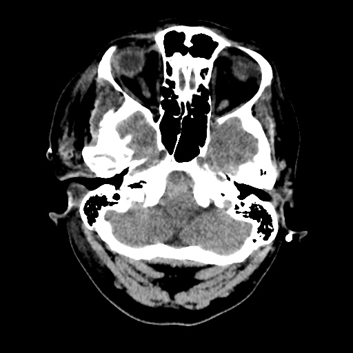 File:Aneursym related subarachnoid hemorrhage with hydrocephalus (Radiopaedia 45105-49085 Axial non-contrast 7).jpg
