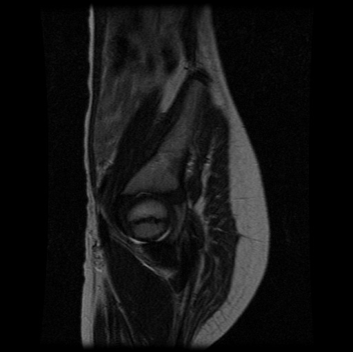 File:Aneurysmal bone cyst - sacrum (Radiopaedia 65190-74196 Sagittal T2 7).jpg
