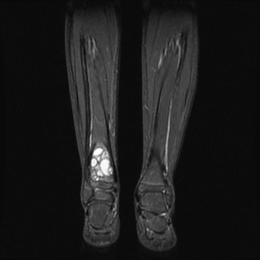 File:Aneurysmal bone cyst - tibia (Radiopaedia 22343-22367 Coronal STIR 11).jpg