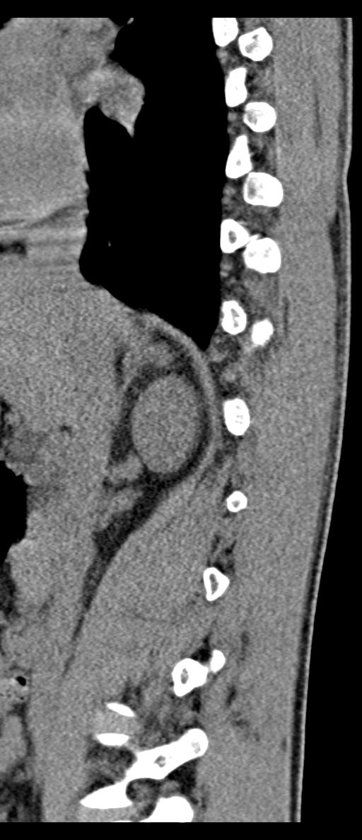 Aneurysmal bone cyst T11 (Radiopaedia 29294-29721 E 58).jpg