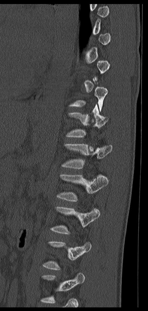 Aneurysmal bone cyst T11 (Radiopaedia 29294-29721 Sagittal bone window 26).jpg