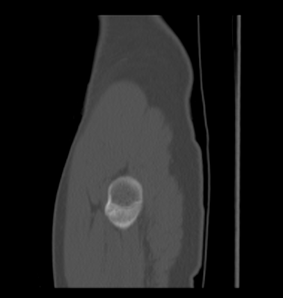Aneurysmal bone cyst of ischium (Radiopaedia 25957-26094 Sagittal bone window 71).png