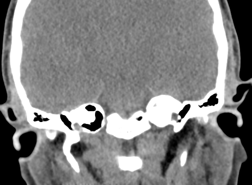 Angular dermoid cyst (Radiopaedia 88967-105790 Coronal non-contrast 71).jpg