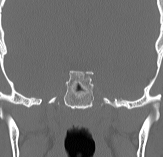 Angular epidermoid cyst (Radiopaedia 46908-51439 Coronal bone window 52).png