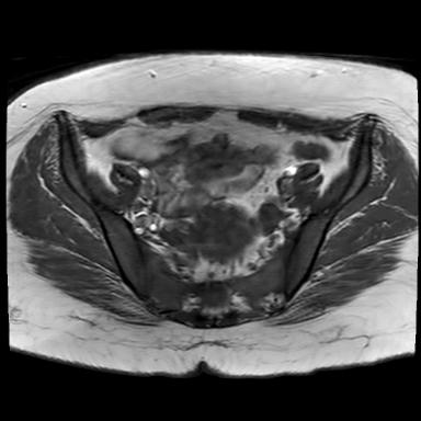 File:Ano-vaginal fistula (Radiopaedia 29765-30284 Axial T1 24).jpg