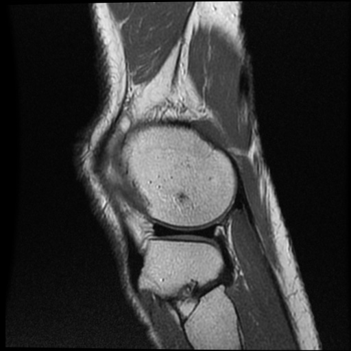 File:Anomalous insertion of the medial meniscus (Radiopaedia 77559-89721 Sagittal PD 12).jpg