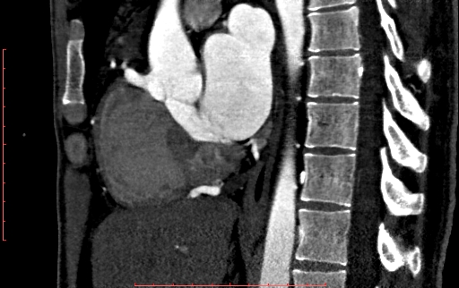 File:Anomalous left coronary artery from the pulmonary artery (ALCAPA) (Radiopaedia 70148-80181 C 114).jpg
